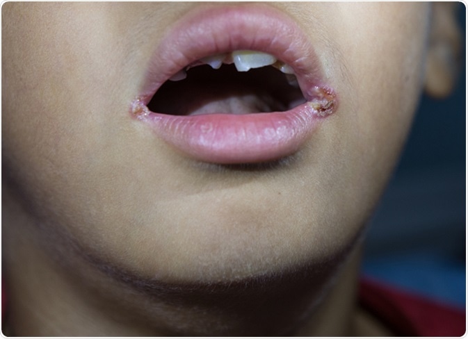 Closeup view of cheilitis founded in an Asian male child. Image Credit: Karan Bunjean / Shutterstock
